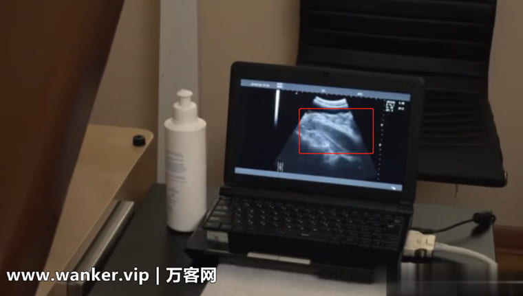 ก้าวหน้าภายใต้ B-ultrasound-Wanke Video